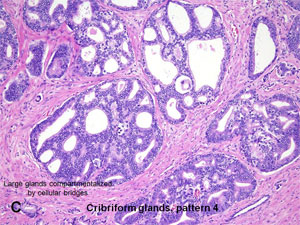 American Urological Association - Prostatic Adenocarcinoma: Gleason ...