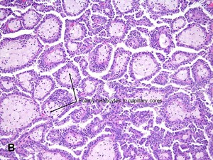 American Urological Association - Papillary Renal Cell Carcinoma