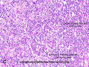 American Urological Association - Urothelial Carcinoma Variants