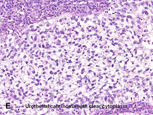 American Urological Association - Urothelial Carcinoma Variants