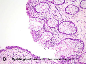 American Urological Association - Cystitis Glandularis