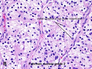 American Urological Association - Clear Cell Renal Cell Carcinoma ...