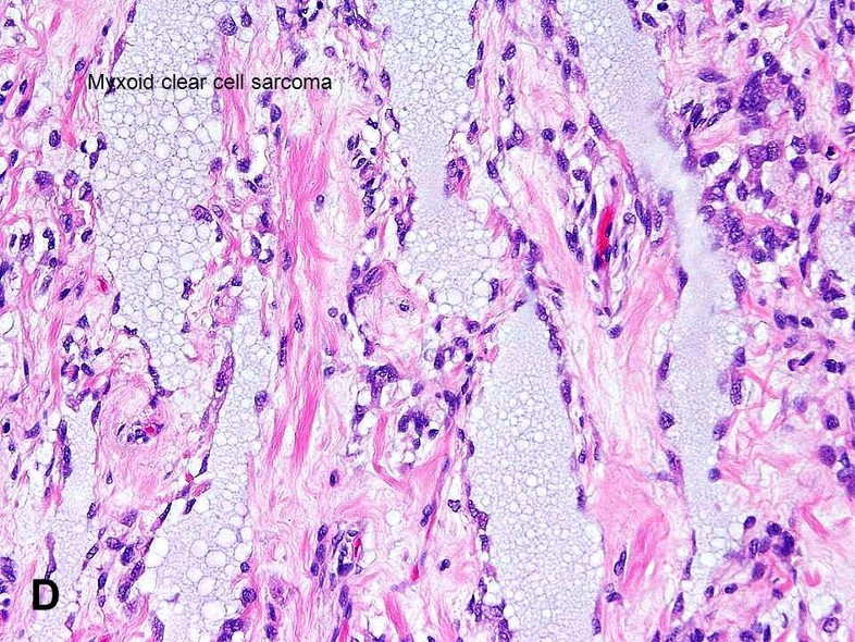 clear-cell-sarcoma-american-urological-association