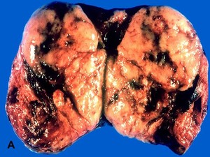 Malignant Rhabdoid Tumor - American Urological Association