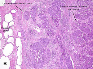 American Urological Association - Urothelial Carcinoma of the Prostate
