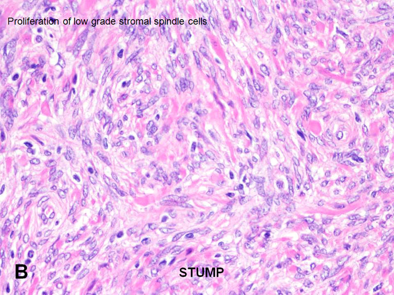 Prostatic Stromal Tumors - American Urological Association