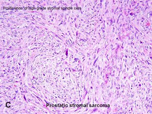 American Urological Association - Prostatic Stromal Tumors