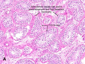 American Urological Association - Intratubular Germ Cell Neoplasia (ITGCN)