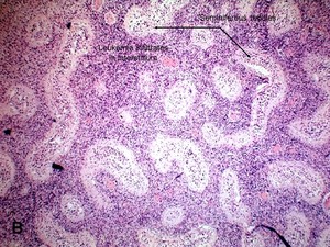 American Urological Association - Myeloid Sarcoma (Leukemia)