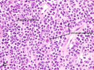 Myeloid Sarcoma (Leukemia) - American Urological Association