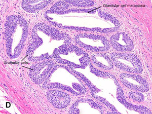 American Urological Association - Urachal Remnant