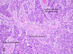 American Urological Association - Invasive Urothelial Carcinoma