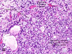 American Urological Association - Nephrogenic Adenoma