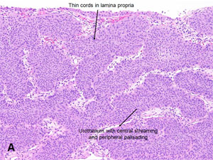 American Urological Association - Inverted Papilloma