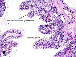 American Urological Association - Clear Cell Papillary Renal Cell Carcinoma