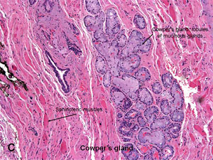 American Urological Association - Prostatic 