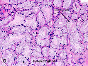 American Urological Association - Prostatic 