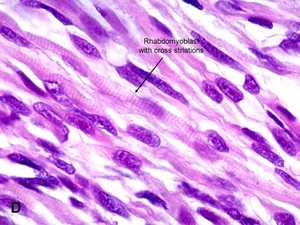 American Urological Association - Rhabdomyosarcoma