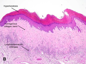 American Urological Association - Balanitis Xerotica Obliterans